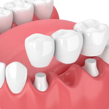 Example of a dental bridge similar to what is placed at Lugoff Smiles