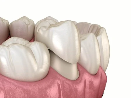 Example of a dental crown like Dr. Sartor would place at Lugoff Smiles